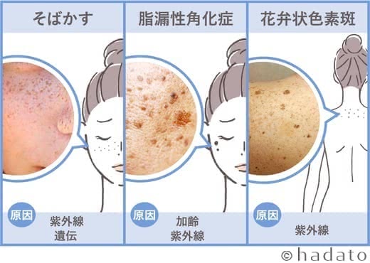 シミ化粧水