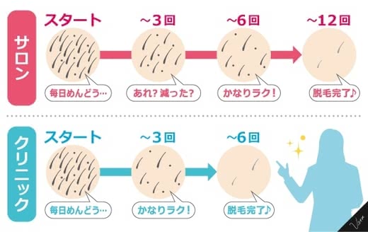 VIO脱毛,おすすめ