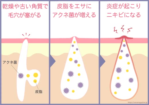 ニキビ化粧水プチプラ