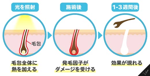 SHR脱毛