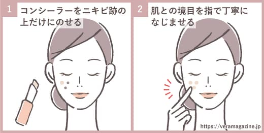 ニキビ跡治す
