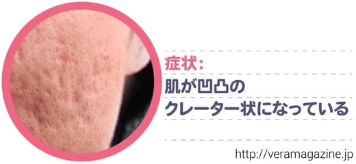 ニキビ跡,化粧水