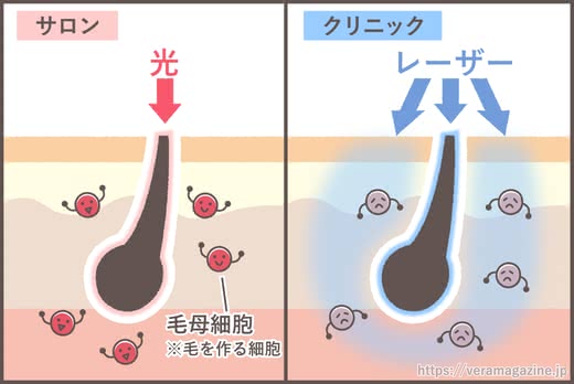 脱毛サロンおすすめ