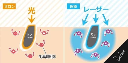 全身脱毛