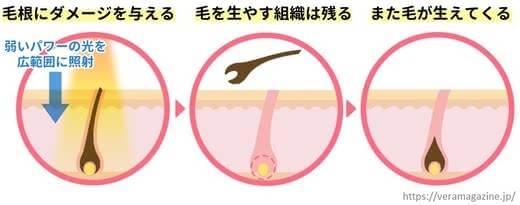 脱毛痛み痛い