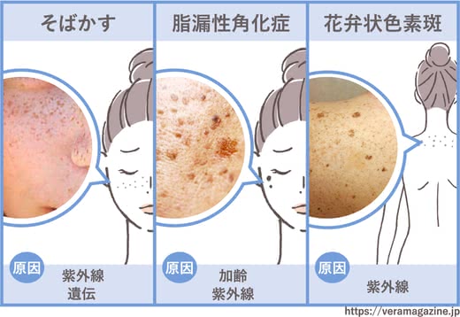 シミ消しクリームおすすめ