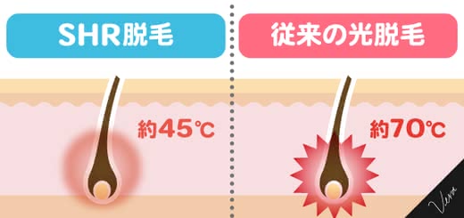 SHR脱毛