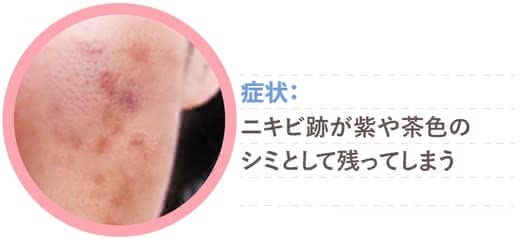 ニキビ跡化粧水