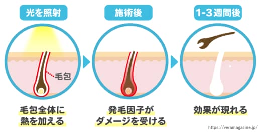 SHR脱毛