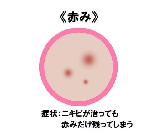 ニキビ治し方大人ニキビ早く治す