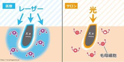 脱毛病院人気おすすめランキング
