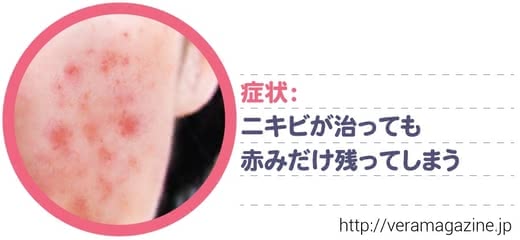 大人ニキビ,赤み