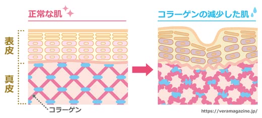 首のしわの原因と改善