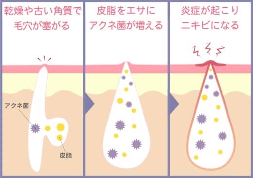 ニキビ化粧水プチプラ