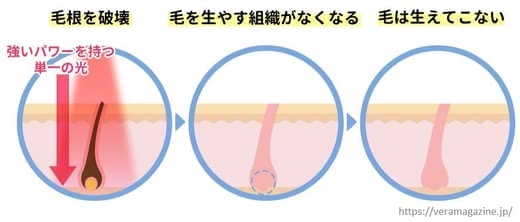 脱毛痛み痛い