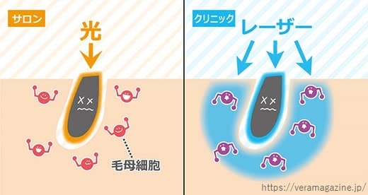 脱毛クリニック人気おすすめランキング