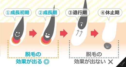 医療脱毛,効果