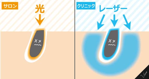脱毛おすすめ