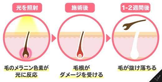 SHR脱毛