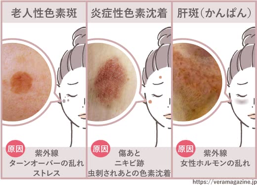シミ取りクリームおすすめ