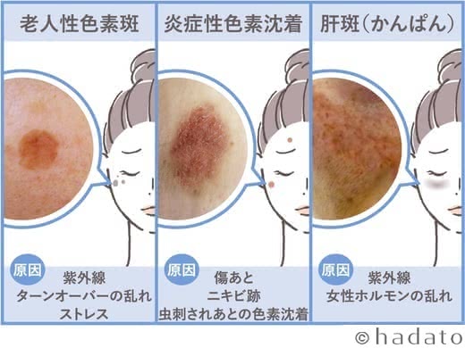 シミ化粧水