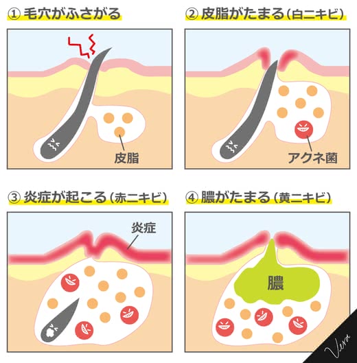 ニキビ,ニキビ跡