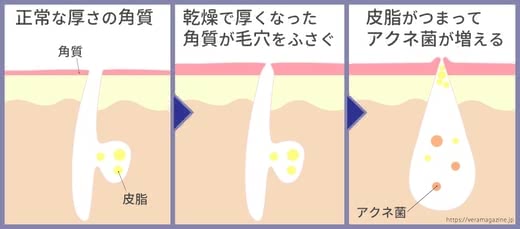 ニキビ保湿ケア