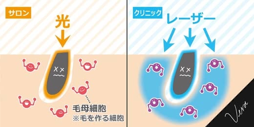 脱毛サロン比較