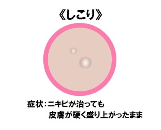 ニキビ治し方大人ニキビ早く治す