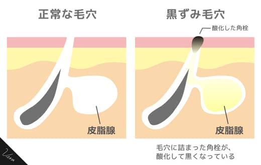 毛穴パック