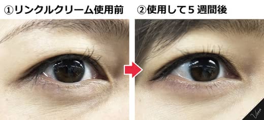 リンクルクリームシワ改善効果口コミ