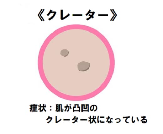 ニキビ治し方大人ニキビ早く治す