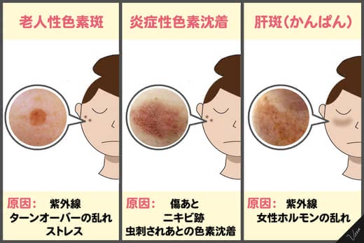 シミ消しクリームおすすめ