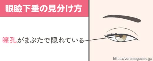まぶたたるみ