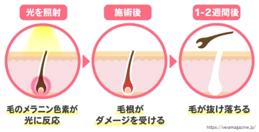 SHR脱毛