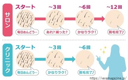 VIO脱毛,おすすめ