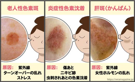 シミ消す