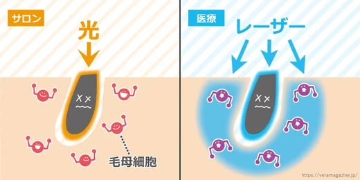 子供脱毛おすすめ