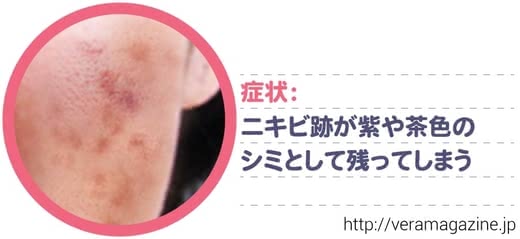 ニキビ跡,化粧水
