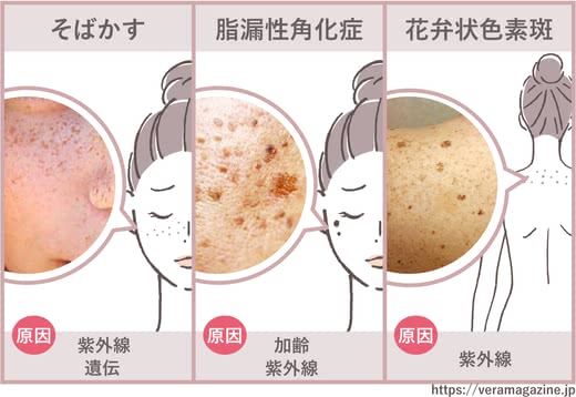 シミ取りクリームおすすめ