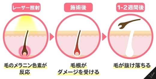 医療脱毛,効果