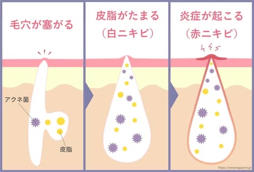 大人ニキビ,化粧水