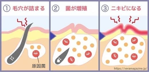 背中,ニキビ