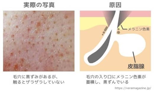 毛穴黒ずみ解消