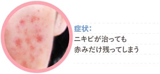 ニキビ跡化粧水