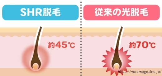 SHR脱毛