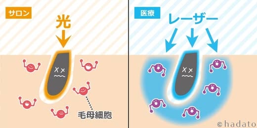 医療脱毛料金おすすめ
