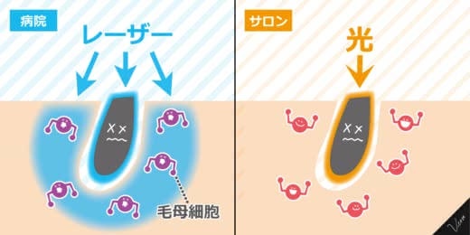 脱毛病院人気おすすめランキング
