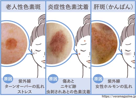 シミ消しクリームおすすめ