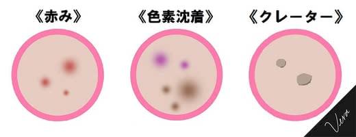 ニキビ,ニキビ跡